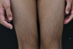 Bé gái mắc bệnh hiếm, thế giới chỉ có 74 ca