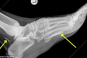 Giun dài cả mét sống trong chân người 4 năm