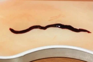 Một người thiệt mạng vì bị giun dài 10cm ‘ăn thận’