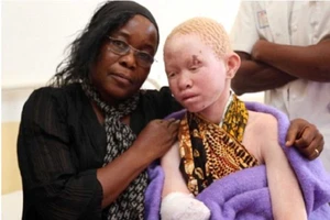 Ở xứ sở người bạch tạng bị đối xử như 'cầm thú'