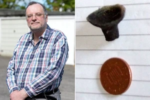 Đồ chơi kẹt trong mũi, 44 năm sau mới phát hiện