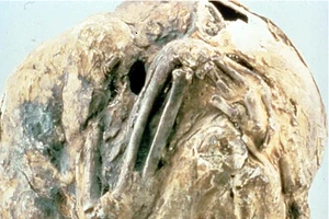 Người phụ nữ mang 'thai đá' hơn nửa thế kỷ