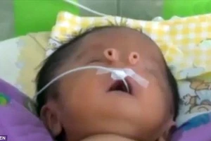 Kỳ lạ em bé sinh ra với hai cái mũi