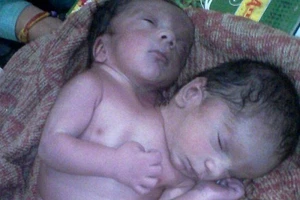 Hy vọng sống sót mong manh của cặp song sinh hai đầu Ấn Độ