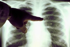 Microsoft sẽ 'trị được' ung thư trong vòng 10 năm tới