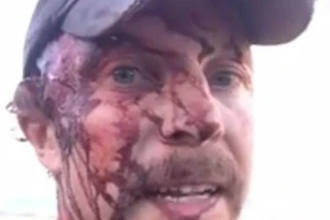 Sống sót kỳ diệu dù bị gấu cắn xé hai lần liên tiếp