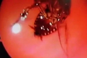 Gián chui qua mũi vào sọ người sống suốt 12 giờ