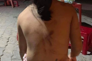 Cháu bé lớp 1 bị bà cố nội đánh bầm hết cả người