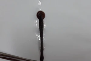 Chảy máu mũi 10 ngày, đến BV được bác sĩ gắp ra con đỉa