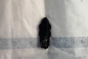 Các bác sĩ đã lấy ra một phần chìa khoá đã gãy màu đen. Ảnh: BV