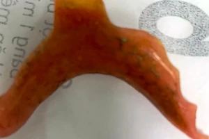  Uống thuốc cảm nuốt luôn răng giả