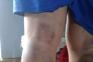 Cô giáo chủ nhiệm đánh học sinh 2 chân bầm tím