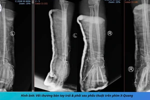 Dập 2 bàn tay do tai nạn pháo nổ