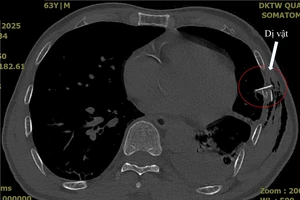 Bệnh nhân gặp tai nạn, bị xương sườn đâm thủng phổi