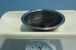 Mổ cấp cứu bé gái mắc bệnh nghiện ăn tóc, lấy búi tóc to ở dạ dày