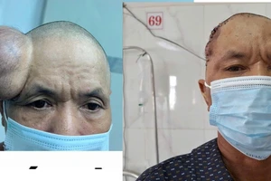 Phẫu thuật khối u dị thường trên vùng đầu người đàn ông 58 tuổi