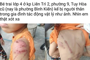 Công an xác minh vụ bé trai bị bạo hành bầm tím người