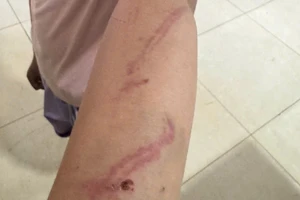 Công an xác minh vụ bé gái 9 tuổi nghi bị mẹ bạo hành