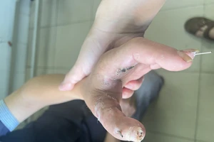 Nối ngón tay giữa vào ngón cái bị cưa máy cắt đứt 