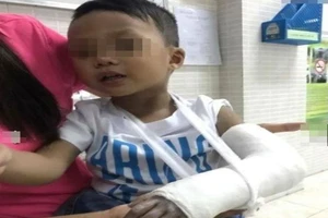 Thực hư vụ “cô giáo đập bàn vô tình làm gãy tay trẻ” 