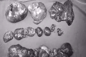 Tưởng béo bụng ai ngờ mang trong mình 20 u mỡ