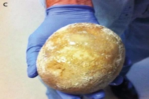 Viên sỏi bàng quang ‘khủng’ to như trứng đà điểu