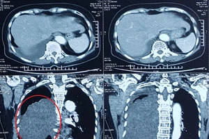 Cắt bỏ khối u ‘khủng’ chèn lệch tim bệnh nhân