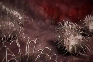 Bị vi khuẩn 'ăn thịt người’ ăn mất nửa gương mặt