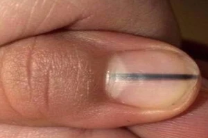 Tưởng chỉ là vết đen trên móng, ai ngờ bệnh chết người