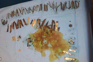 Mổ lấy 100 mảnh dao, móng tay, đinh vít trong bao tử