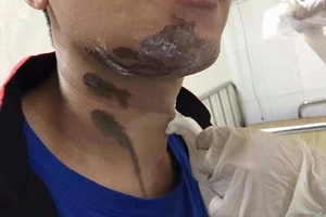 Bỏng nặng vì nước rửa bồn cầu văng trúng người