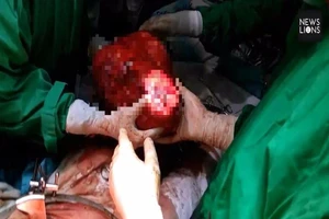 Cắt bỏ khối u thận khủng to bằng trái banh bowling