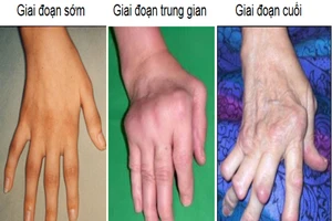 Bệnh gì dễ nhầm với gút?