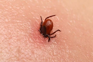 Liệt, mất trí nhớ vì bị ve cắn 16 năm trước