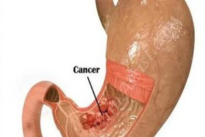 Có những dấu hiệu này cần nghĩ ngay đến ung thư dạ dày