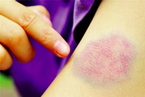 Dấu hiệu nhận biết ung thư máu