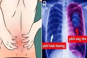 Ðau lưng phía sau phổi có phải dấu hiệu ung thư?
