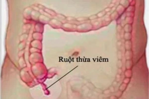 Hút 4 lít dịch mủ trong bụng sản phụ viêm ruột thừa vỡ hoại tử
