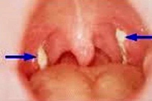 1 em bé tử vong do bị bệnh bạch hầu, nhiều người lây nhiễm