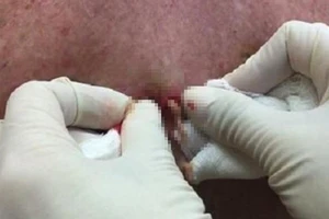 Coi chừng mất mạng vì thói quen nặn mụn 