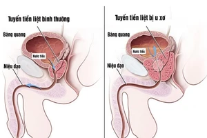 Tuyến tiền liệt bình thường và tuyến tiền liệt bị u xơ. Ảnh: Internet