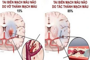 Tai biến mạch máu não: Cấp cứu thế nào để tránh tử vong?