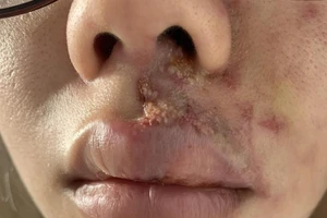 Mặt sưng phù, mưng mủ sau tiêm filler làm đầy rãnh má