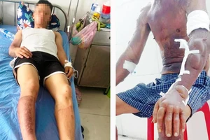 Bình xịt kiến phát nổ khiến 2 người bị bỏng nặng