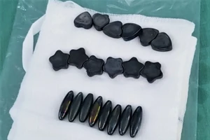 Nuốt 20 viên nam châm vì tưởng là kẹo, bé trai phải cắt bỏ đoạn ruột 15cm