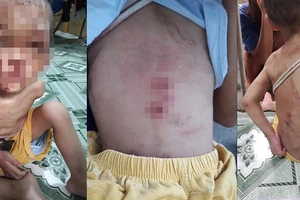 Tình hình sức khỏe bé trai 2 tuổi ở Hóc Môn bị bạo hành 