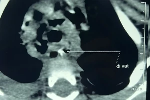 Bé gái 10 tháng tuổi nguy kịch do hóc xương lươn