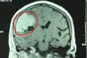 Đi khám đau đầu, phát hiện khối u màng não to hơn quả trứng