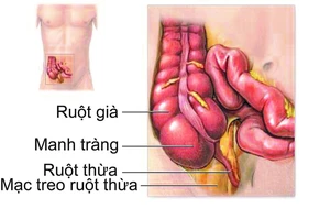 Vụ 'viêm ruột thừa, cắt buồng trứng': Rất dễ chẩn đoán nhầm!