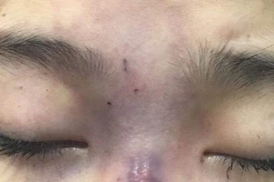 Hai phụ nữ bị tai biến và mất tài sản sau khi tiêm filler ở khách sạn